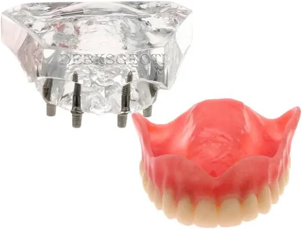 DEBKSGEOTI Dental Implant Typodont Restoration Teeth Model M6001 Clear Overdenture 4 Implants Superior Upper Demo for Study Teach