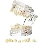 Dentalmall Dental Oral Typodont Model Implant Pathological Removable Teach Demo visible Anatomy